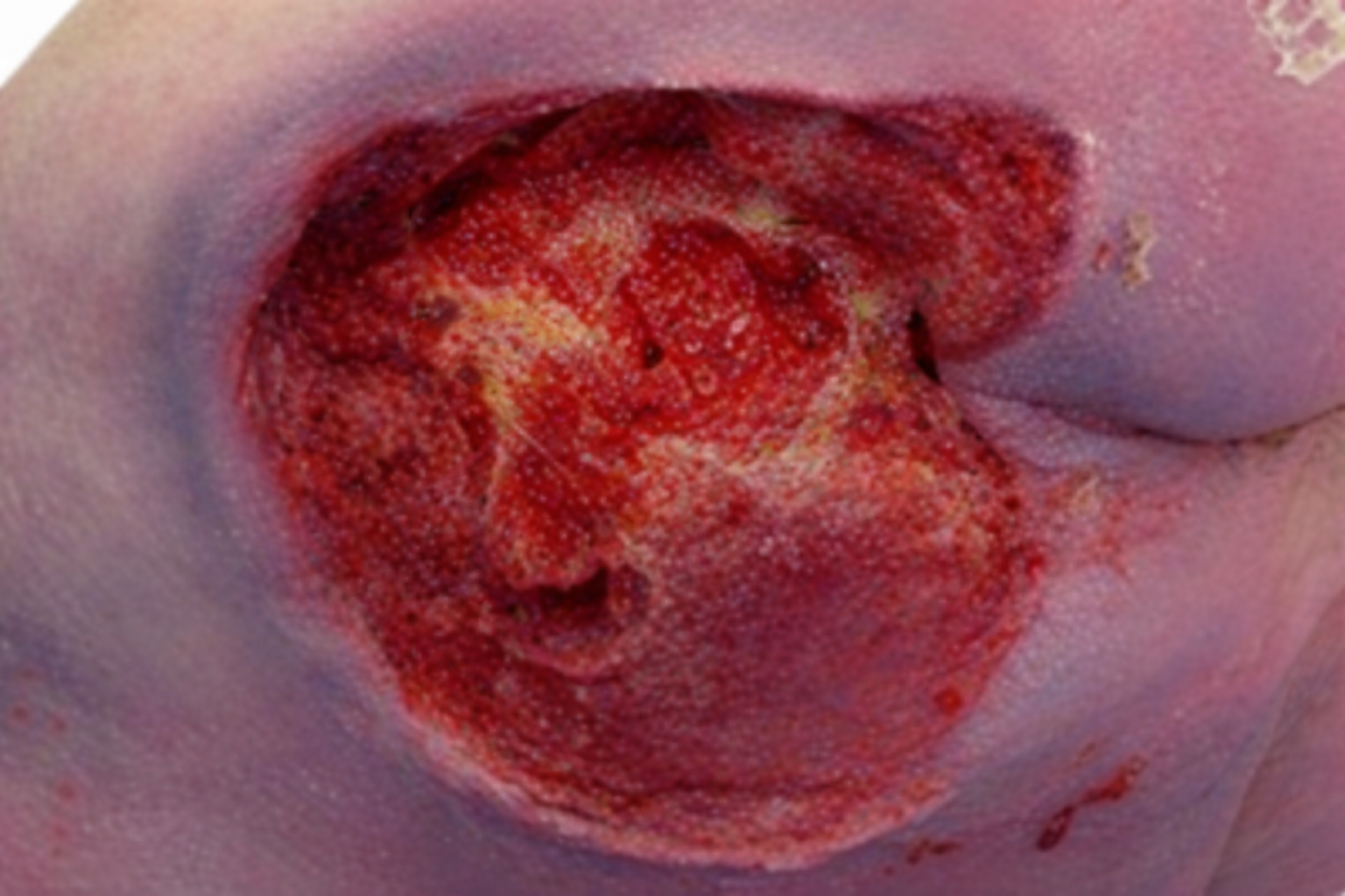 Dekubitus / Druckgeschwür